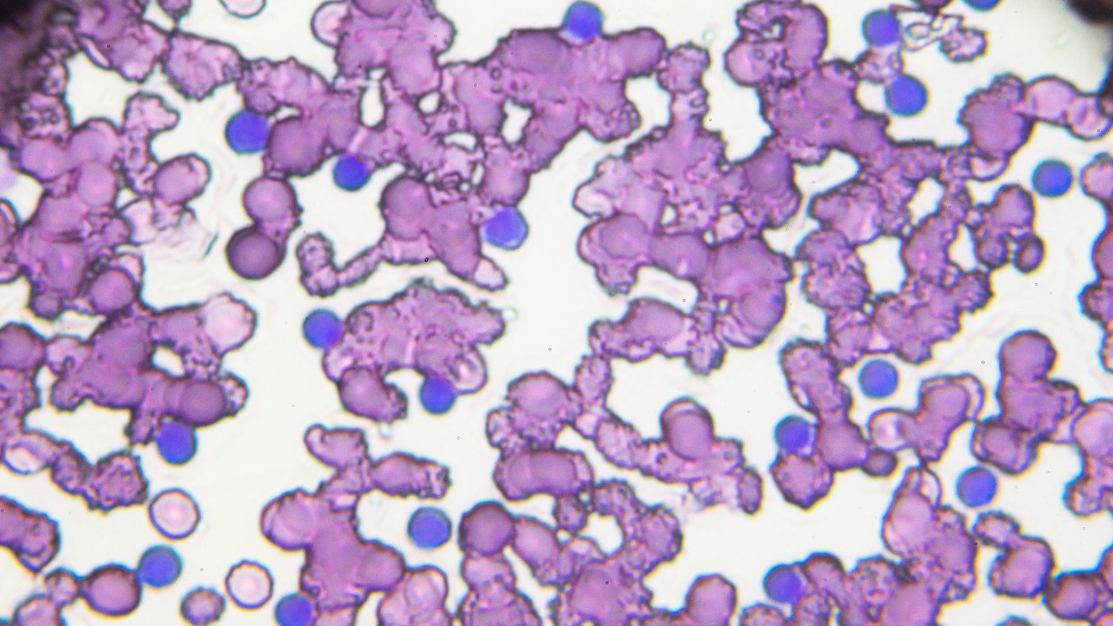 CLL treatment